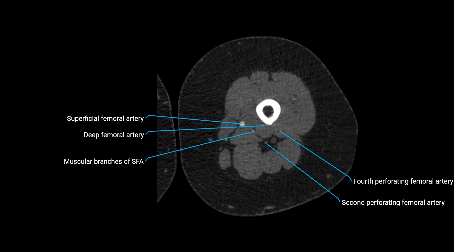 CTA lower limb cross sectional anatomy labelled image _133.webp